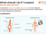Sarcoma CONNECT Bone Sarcoma Flashcard